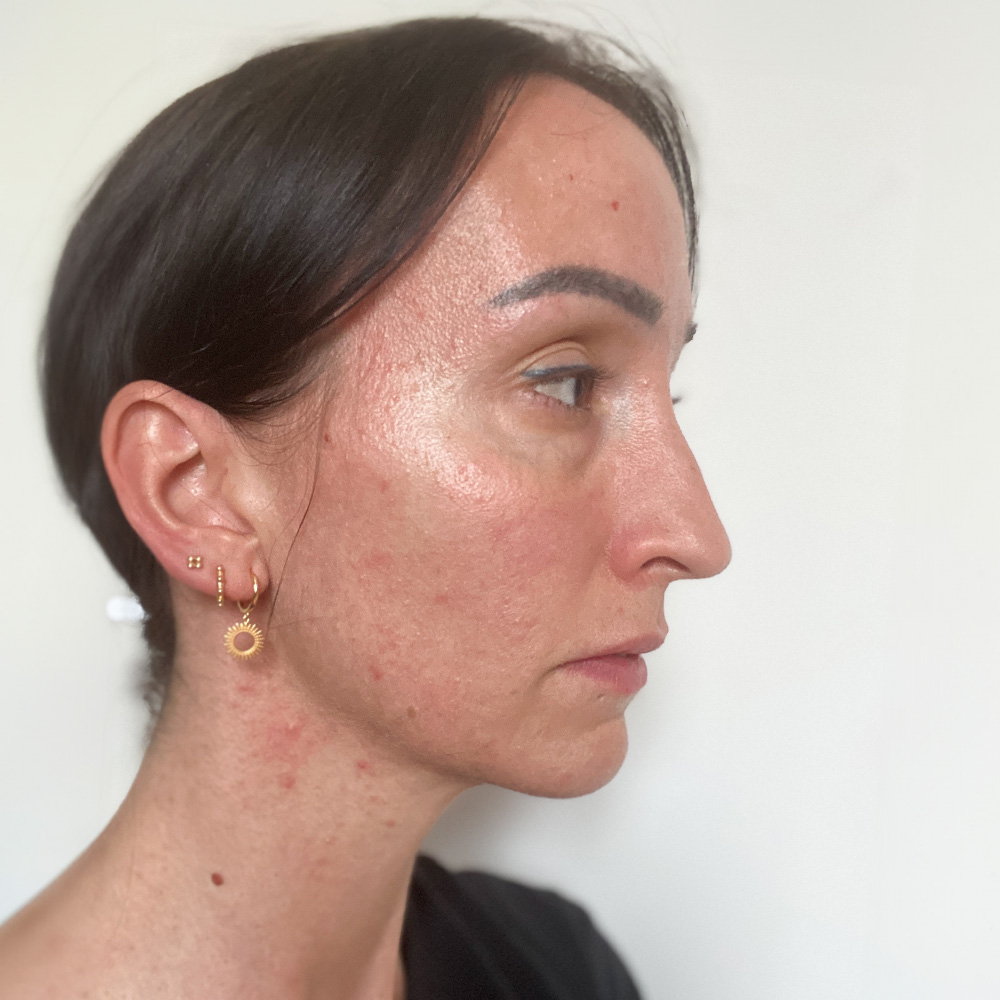 Tanja Resultate Skin Clear Adult ölige Haut Pickel Before