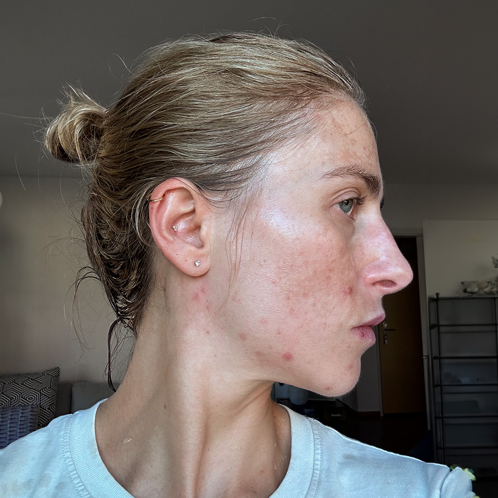 Tanja Behandlung Pigmentflecken Altersflecken before