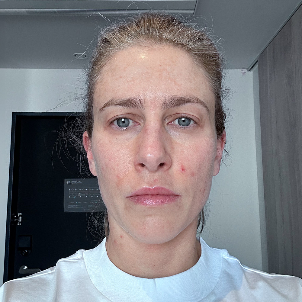 Tanja Behandlung Pigmentflecken Altersflecken after